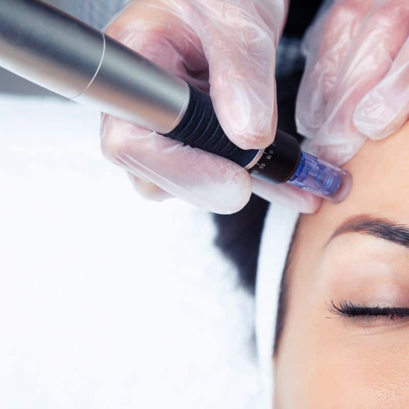 Morpheus8 treatment Kings Lynn from Lipo Sculpt - Book in today!