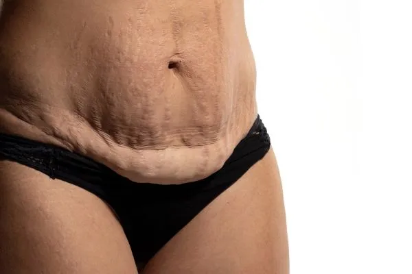 Lost the Weight but Not the Loose Skin? 1 image of womans stomach after weight loss showing loose skin Kings Lynn